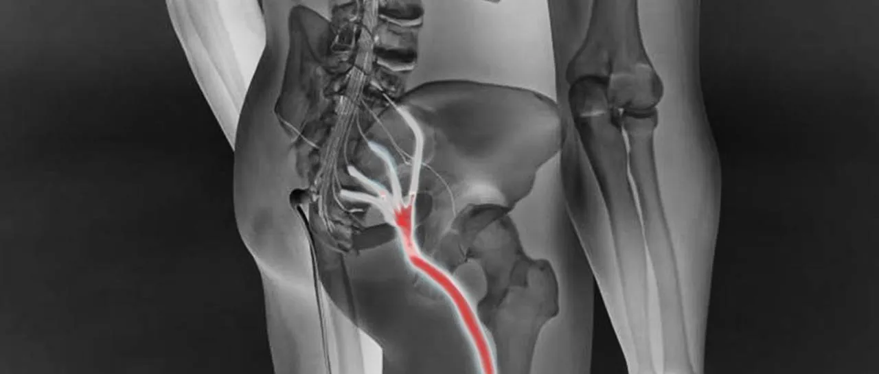 Dor no Nervo Ciático