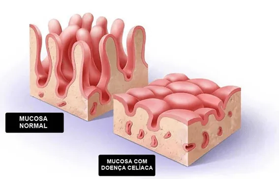 Comparação intestino normal vs celíaco