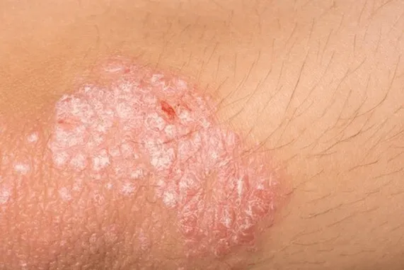 Eczema