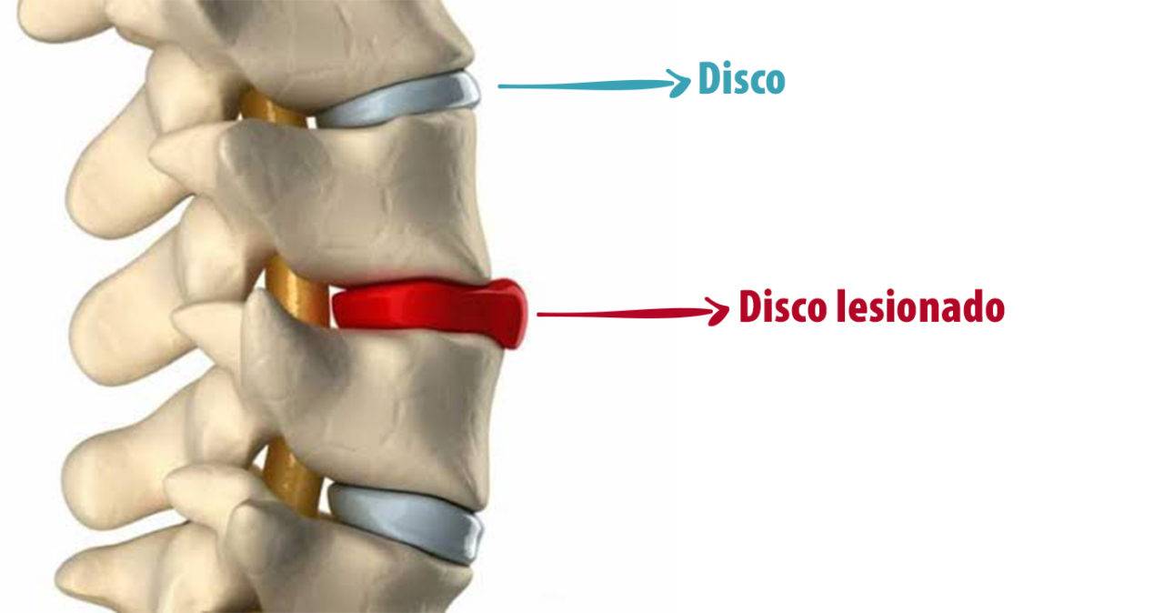 Hérnia de disco métodos pouco conhecidos para se tratar em casa